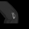 SPORK, NICO - 22.03.1976 - 02.08.2022 - CT obere Extremität - 18:01:46